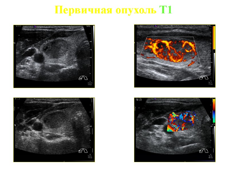 Первичная опухоль T1